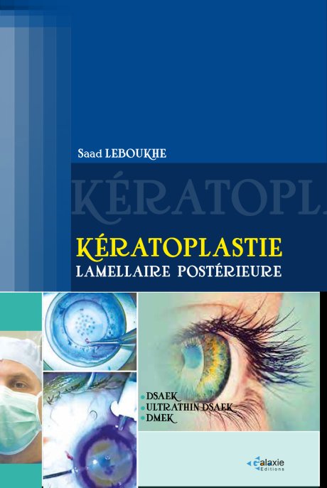 KÉRATOPLASTIE LAMELLAIRE POSTÉRIEURE