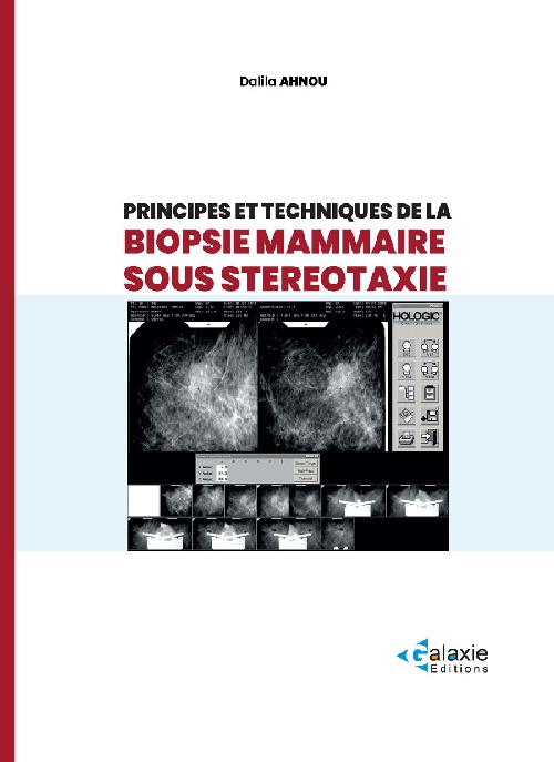 Principes et Techniques de la BIOPSIE MAMMAIRE SOUS STÉRÉOTAXIE