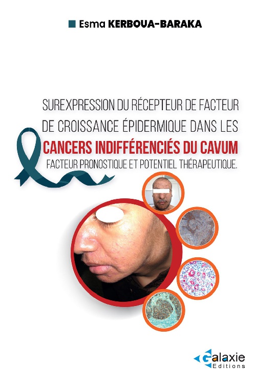 Surexpression du Récepteur de Facteur de Croissance Épidermique dans les CANCERS INDIFFÉRENCIÉS DU CAVUM