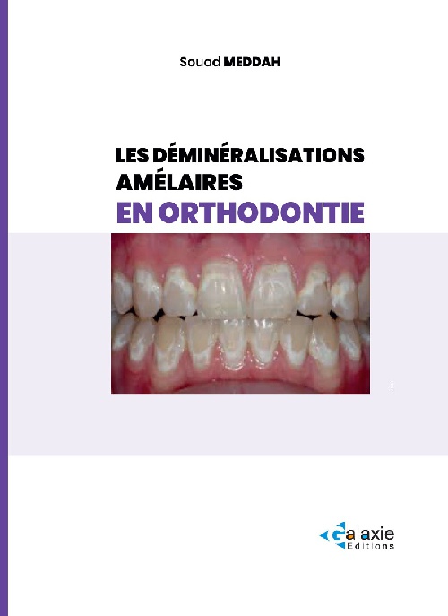 Les Déminéralisations AMÉLAIRES en Orthodentie
